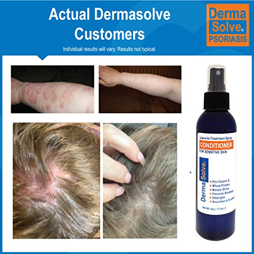 DermaSolve Psoríase Leave-no-tratamento e condicionador de spray de estilo para dermatite seborréica, pele sensível, desembaraço,