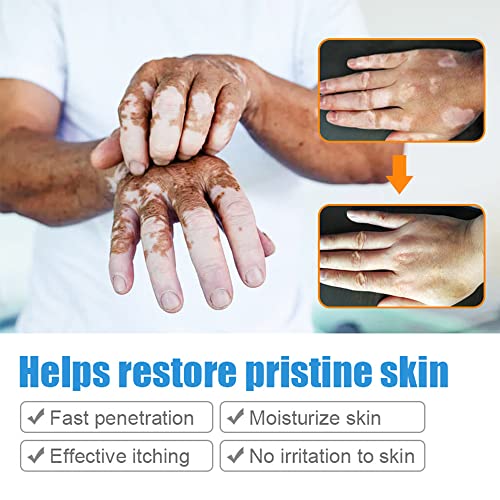 Creme de Manam Vitiligo, Creme de Cuidado de Vitiligo para Vitiligo da Pele, reduz a mancha branca, psoríase, leucoplasia, tratamento