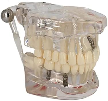 Modelo de dentes de doenças transparentes de Suzla Modelo de dentes de implantes dentários para a aprendizagem de estudantes