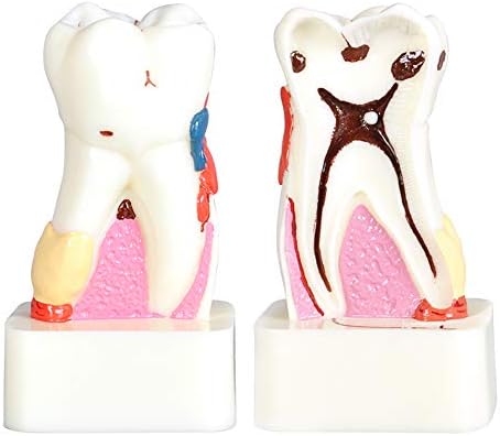 KH66ZKY 4 vezes Modelo de cárie dentária Modelo de dente abrangente de dente cárie Cálculo Modelo de demonstração de estado
