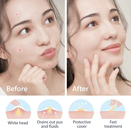 Medtecs acne remendos - tratamento invisível de acne hidrocolóide, absorvendo adesivos de zit para o rosto, omo manchas