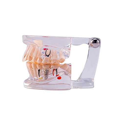 Modelo de patologia dental do Snawop com dentes de implante e doenças transparentes de dente padrão para dentista e educação