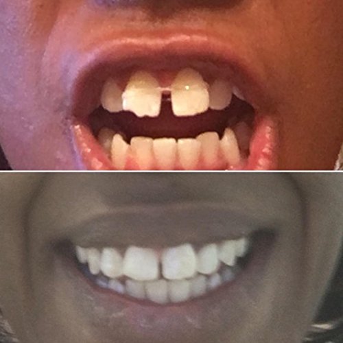 Bandas de dentes de lacunas ortodônticas 3/16 pesado e fio dental, 1 pacote de 100