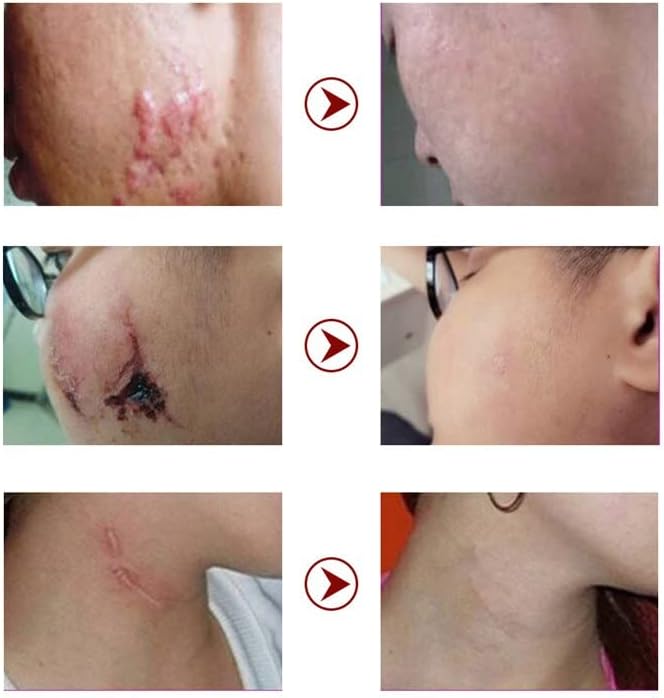 Creme de remoção da cicatriz Remova o tratamento da acne marcação estrias queimam o reparo cirúrgico do creme de pele Creme de clareamento